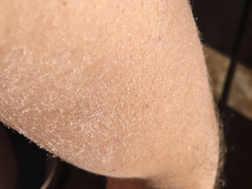 Braço coberto de sal depois de sair da lagoa